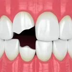 شکستن ایمپلنت دندان