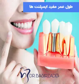 طول-عمر-مفید-ایمپلنت-ها