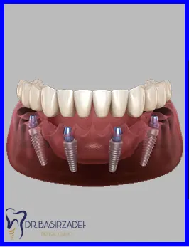 عوارض-و-خطرات-ایمپلنت-دندان