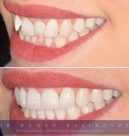 ارتودنسی دندان و انواع ارتودنسی دندان