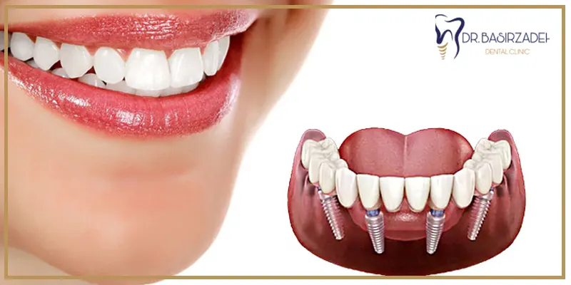 انواع-ایمپلنت-دندان-از-لحاظ-نحوه-کاشت