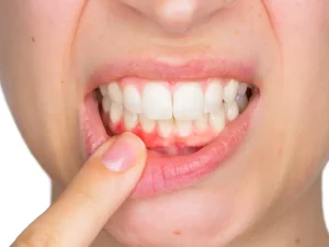 تحلیل لثه بعد از ایمپلنت
