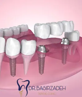 تعریف-ایمپلنت-دندان