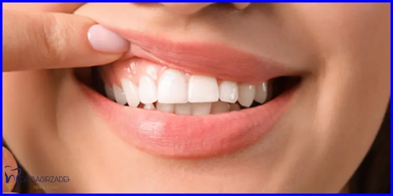 جلوگیری-از-تحلیل-لثه-بعد-از-ایمپلنت-دندان