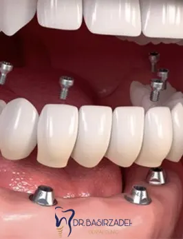روش-تقسیم-بندی-ایمپبنت-دندان